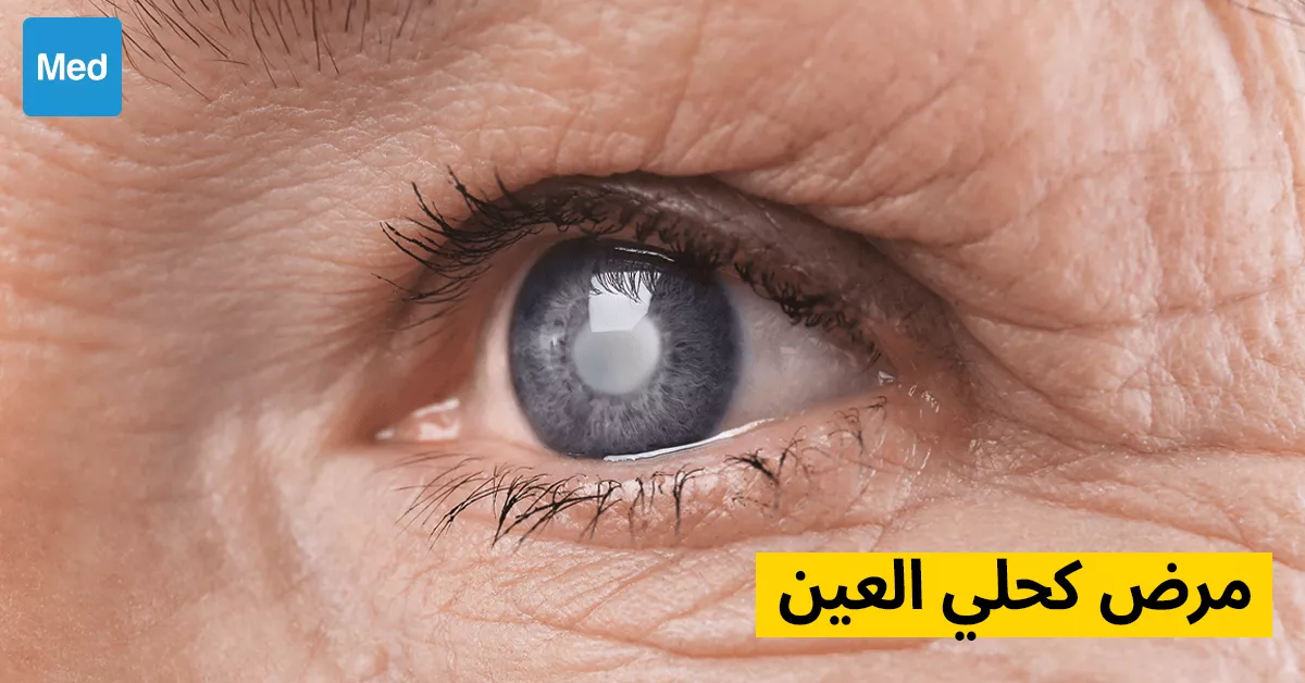 مرض كحلي العين
